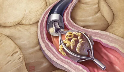 2. إزالة الحصيات بالمنظار المرن تُستخدم هذه التقنية الحديثة لعلاج الحصيات الموجودة في الحالب أو الكلية، خاصة عندما تكون الحصاة أكبر حجماً أو عندما لا تنجح طرق التفتيت الأخرى. يتم إدخال منظار رفيع ومرن عبر مجرى البول دون أي شق جراحي للوصول إلى الحصاة داخل الكلية أو الحالب، ثم يتم تفتيتها باستخدام أشعة الليزر وإزالة الأجزاء الصغيرة. مميزات المنظار المرن: دقة عالية في الوصول إلى الحصيات تفتيت الحصاة بالكامل باستخدام الليزر إجراء بدون جراحة مفتوحة نسبة نجاح مرتفعة