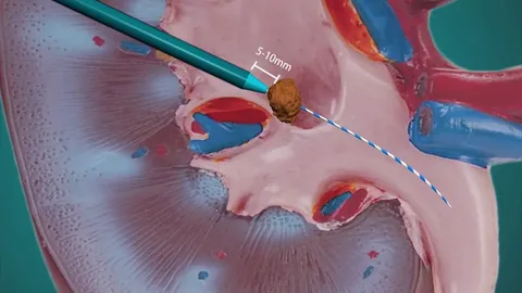 طرق علاج الحصيات البولية 1. تفتيت الحصيات بالموجات التصادمية من خارج الجسم (ESWL) تُعد هذه الطريقة من أكثر الطرق شيوعاً وأماناً لعلاج الحصيات الصغيرة والمتوسطة. تعتمد التقنية على إرسال موجات تصادمية مركزة من خارج الجسم لتفتيت الحصاة إلى أجزاء صغيرة يمكن أن تخرج لاحقاً مع البول بشكل طبيعي. مميزات هذه الطريقة: إجراء غير جراحي لا يحتاج إلى شق جراحي فترة تعافٍ قصيرة يمكن للمريض العودة إلى حياته الطبيعية بسرعة